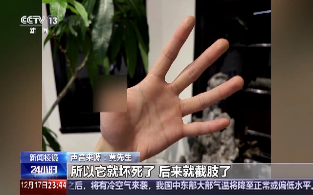 男子养异宠被咬致截肢